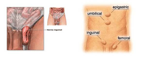 7 fatores de risco para a hérnia inguinal - SBH